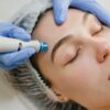 Microneedling-Exosomes