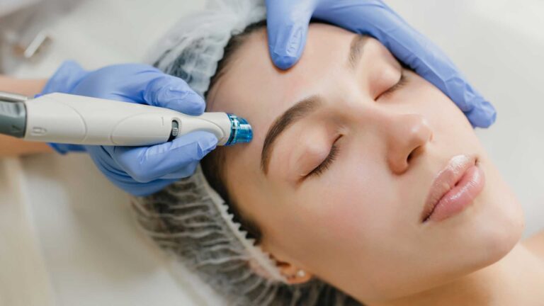 Microneedling-Exosomes