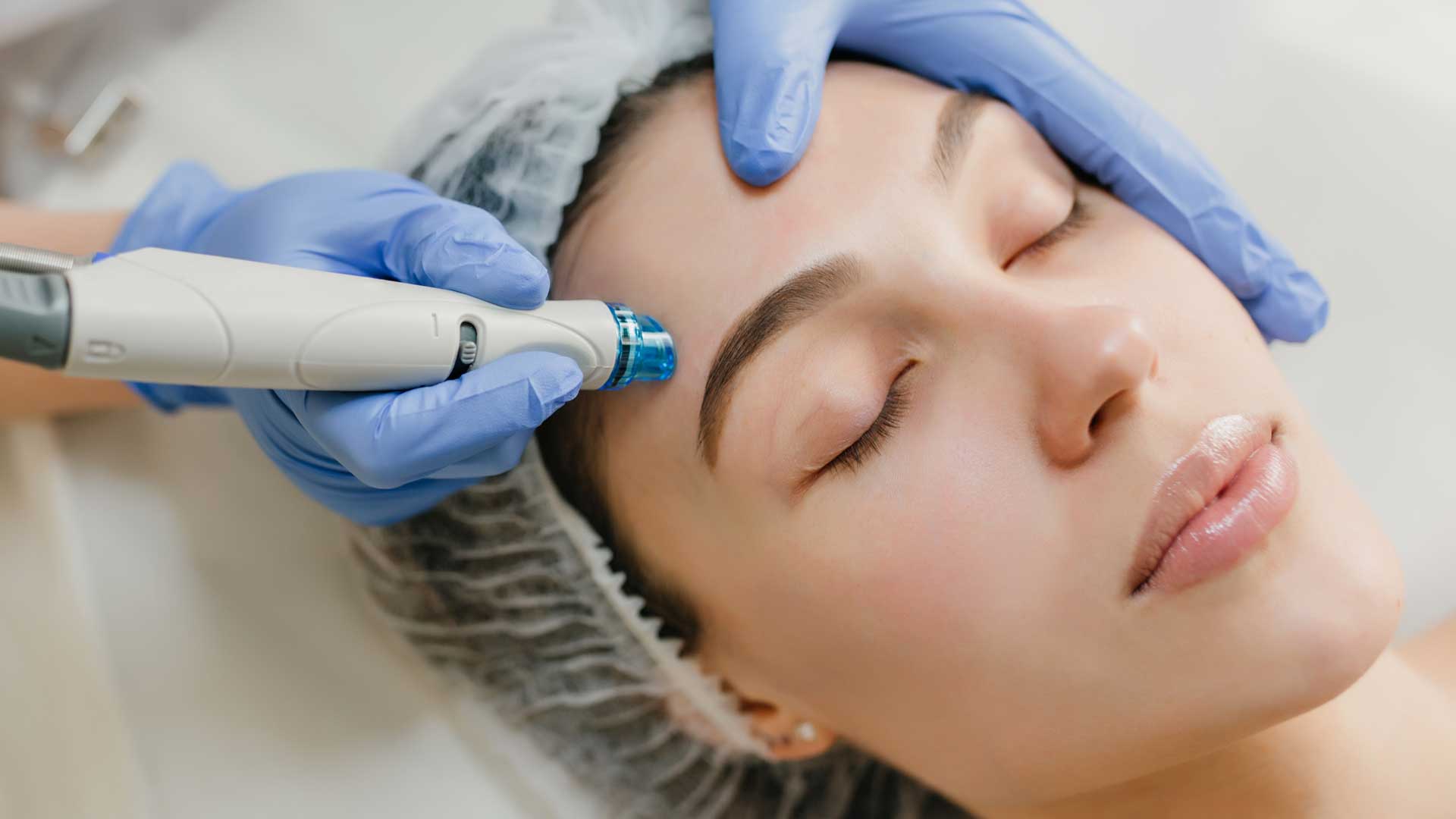 Microneedling-Exosomes
